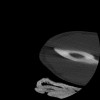 SPORK, NICO - 22.03.1976 - 02.08.2022 - CT obere Extremität - 17:51:17
